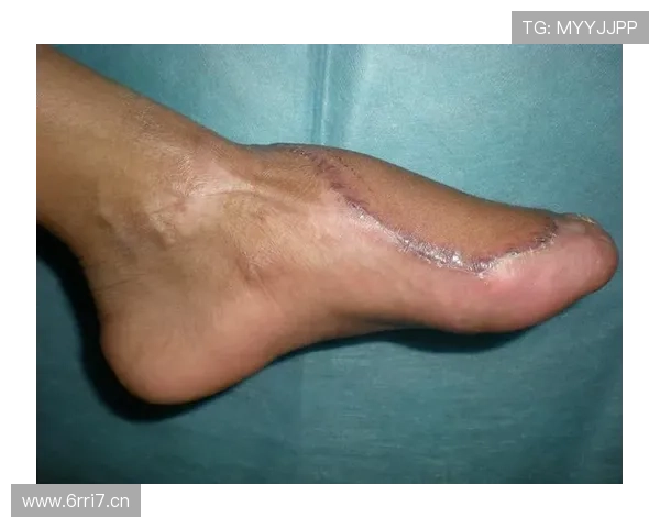 格里利什足部手术自宣赛季报销